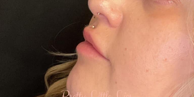 Before Image: Lip Filler - left-front-oblique