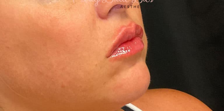 After Image: Lip Filler - right-front-oblique