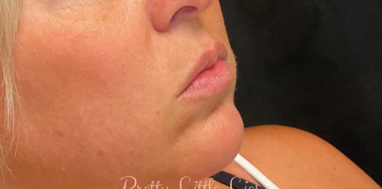 Before Image: Lip Filler - right-front-oblique