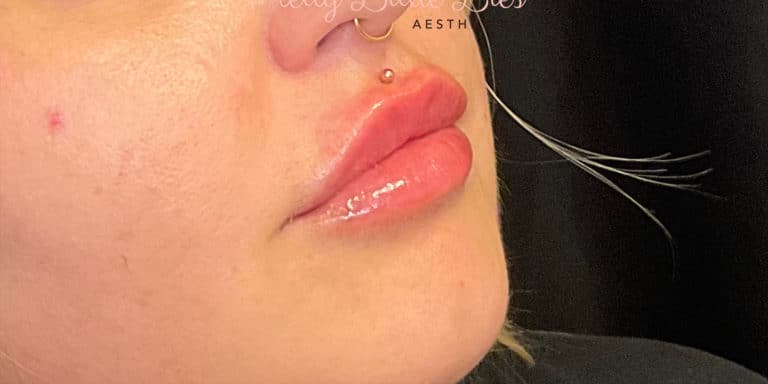 After Image: Lip Filler - right-front-oblique