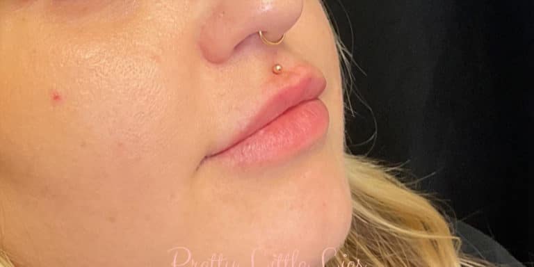Before Image: Lip Filler - right-front-oblique