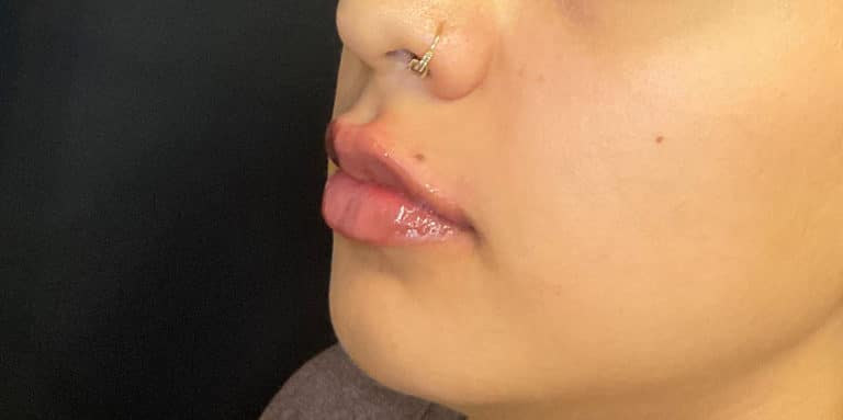 After Image: Lip Filler - left-front-oblique
