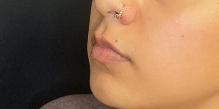 Before Image: Lip Filler - left-front-oblique