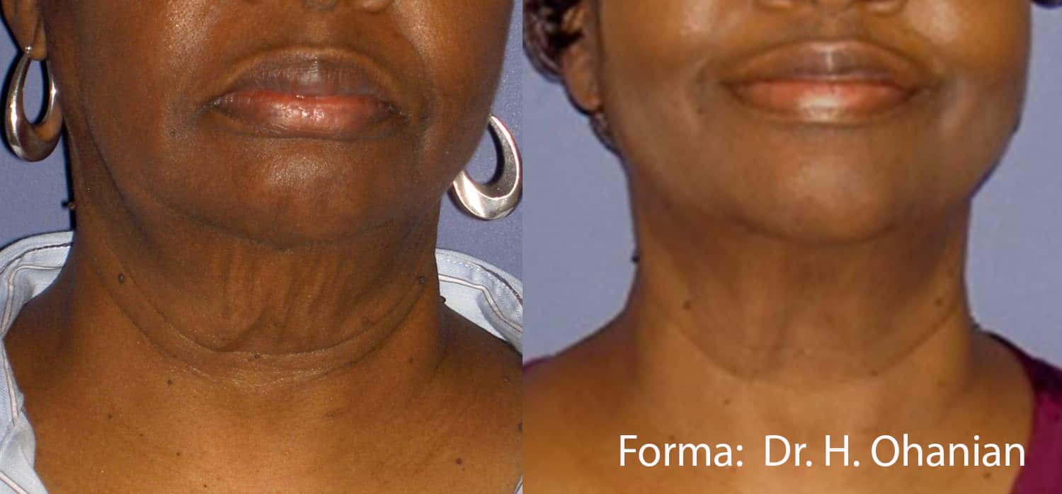 forma before after dr h ohanian preview 3