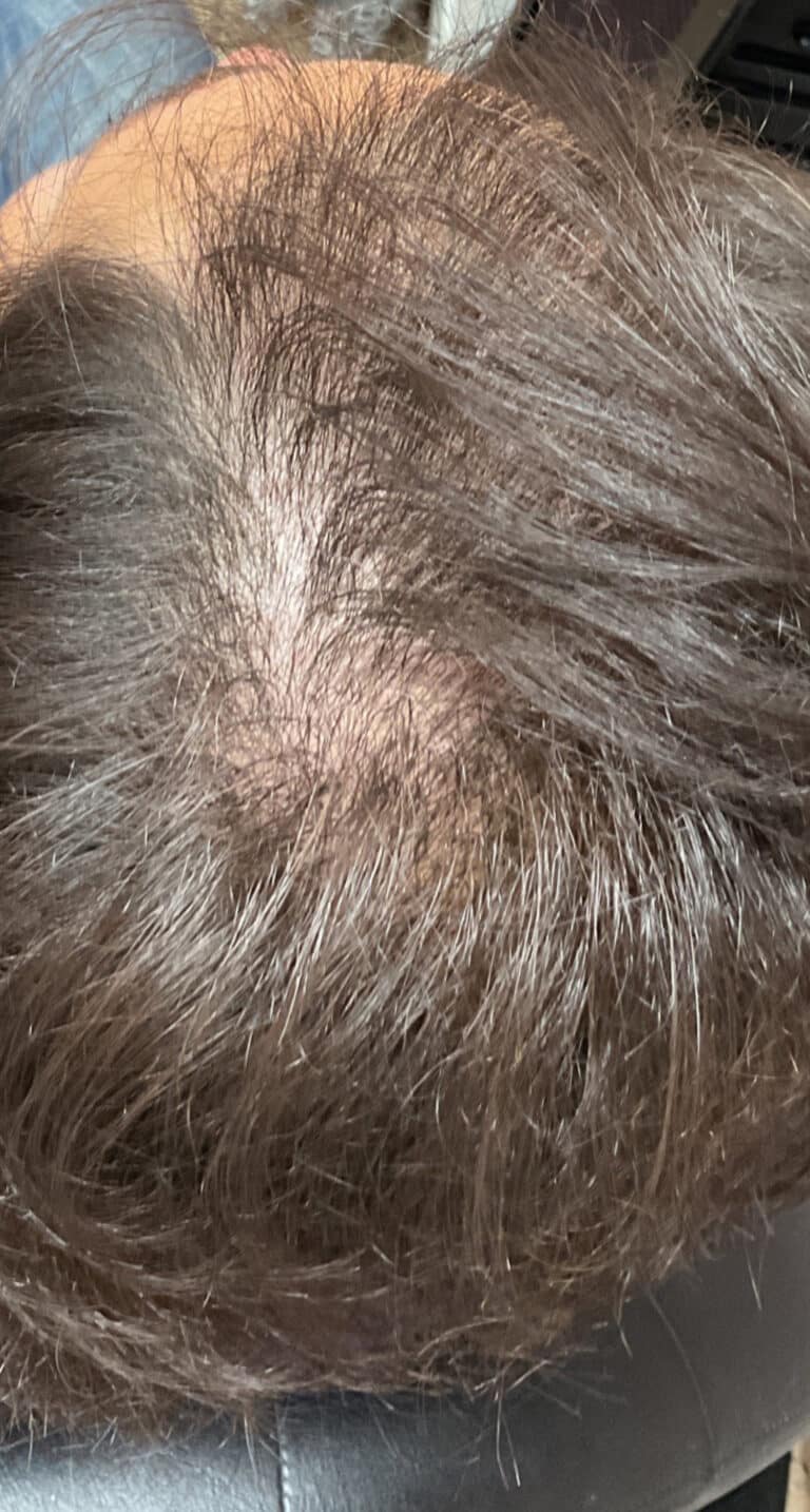 After Image: Hair Restoration - front