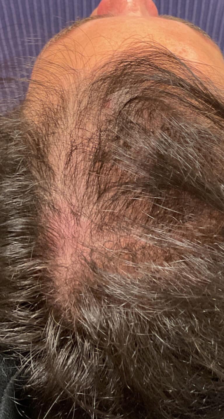 Before Image: Hair Restoration - front