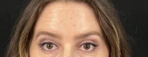 After Image: Botox
