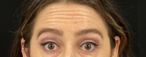 Before Image: Botox