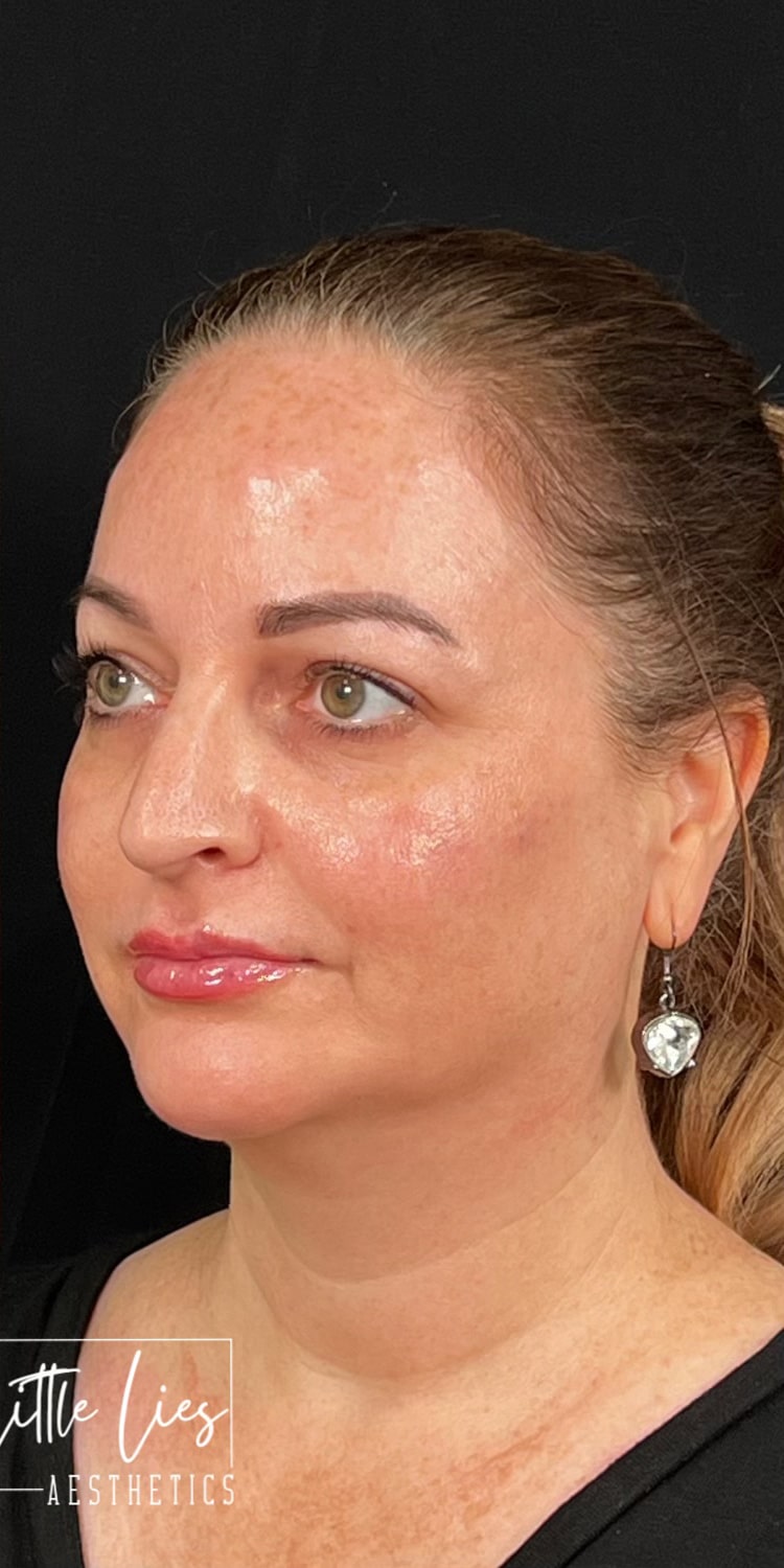 After Image: Full Face Filler - left-front-oblique
