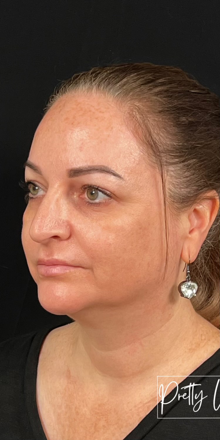 Before Image: Full Face Filler - left-front-oblique