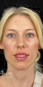 After Image: Full Face Filler
