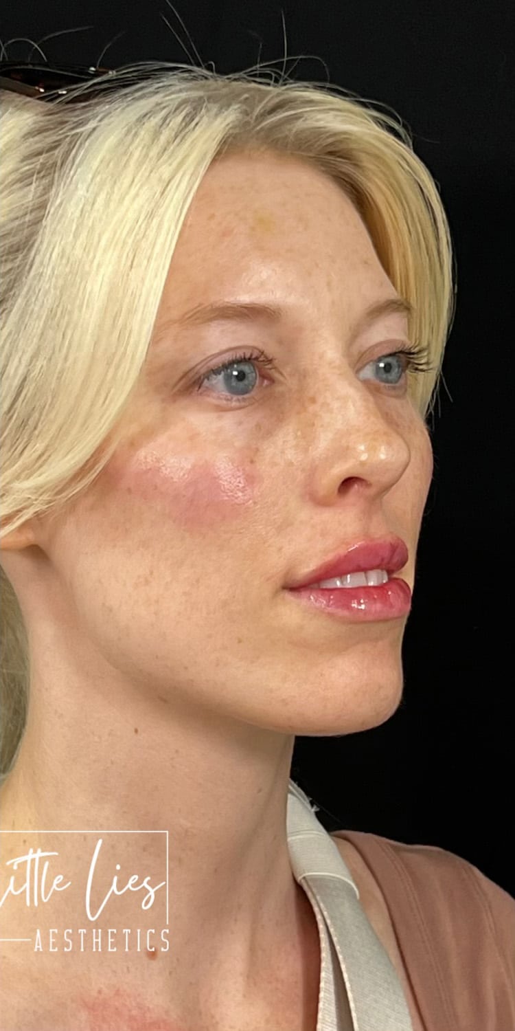After Image: Full Face Filler - right-front-oblique