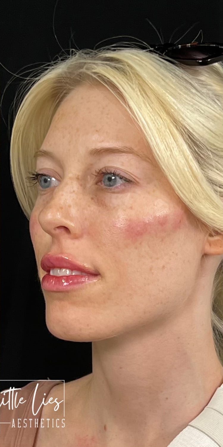 After Image: Full Face Filler - left-front-oblique