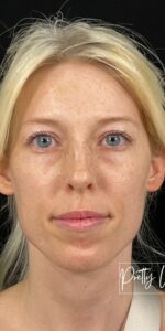 Before Image: Full Face Filler