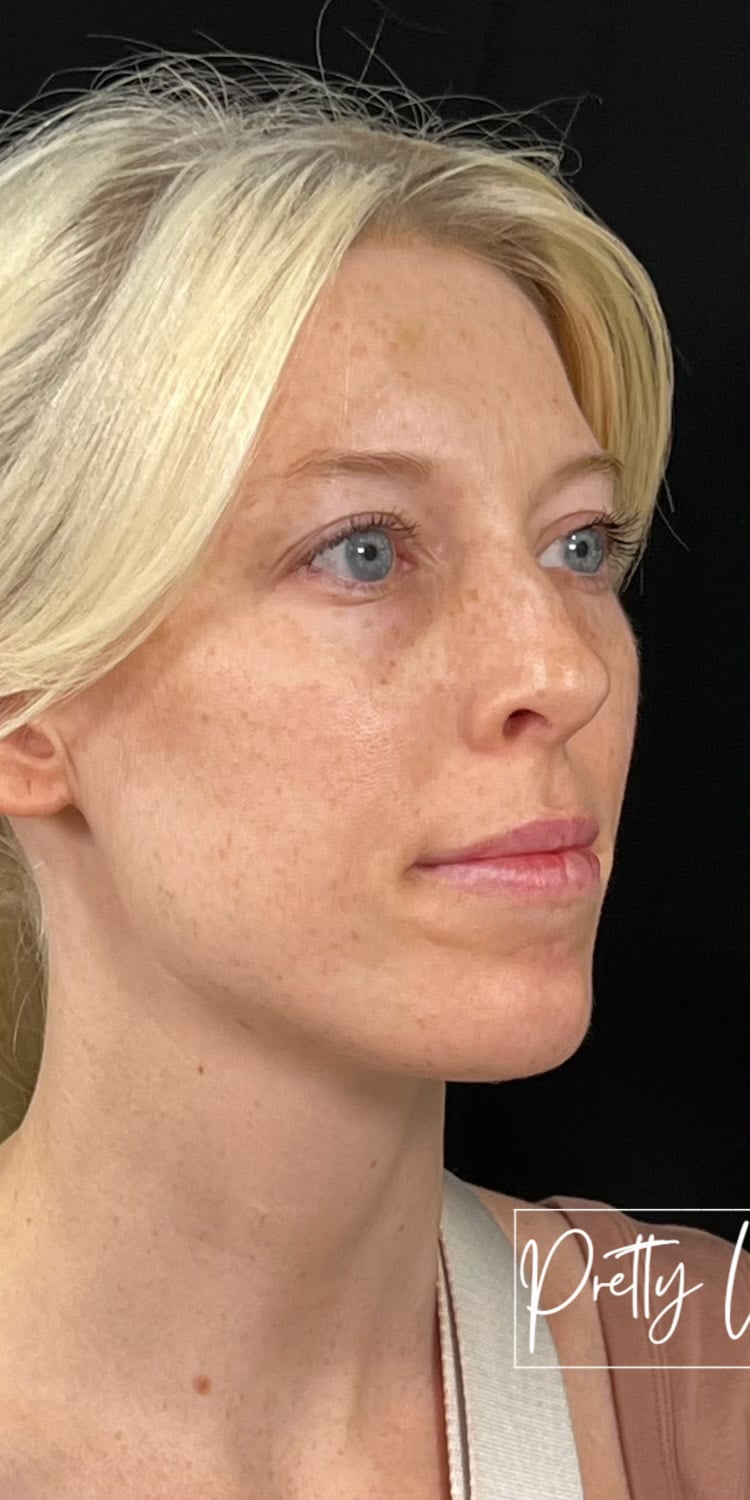 Before Image: Full Face Filler - right-front-oblique