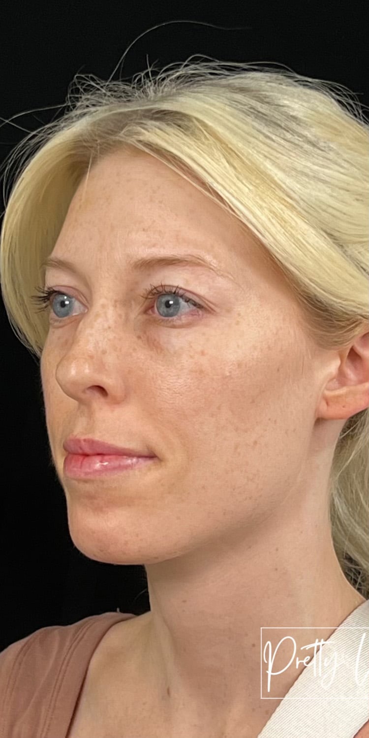 Before Image: Full Face Filler - left-front-oblique