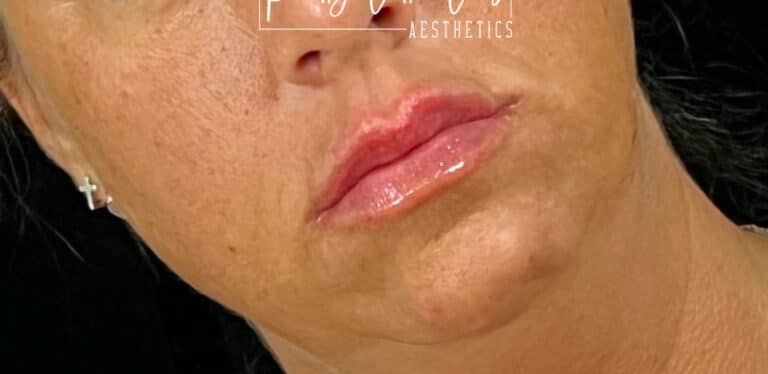 After Image: Lip Filler - right-front-oblique
