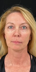 After Image: Full Face Filler