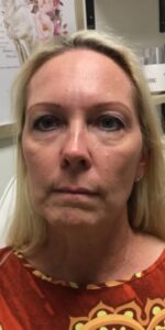Before Image: Full Face Filler