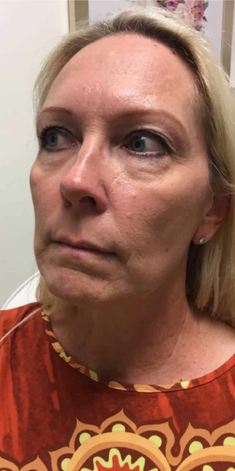 Before Image: Full Face Filler - left-front-oblique