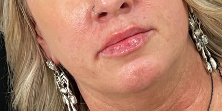 After Image: Lip Filler - right-front-oblique