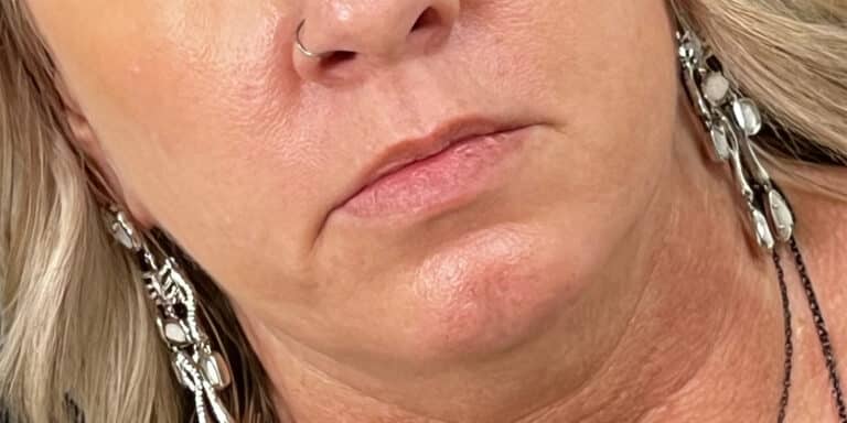 Before Image: Lip Filler - right-front-oblique
