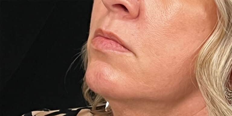 Before Image: Lip Filler - left-front-oblique