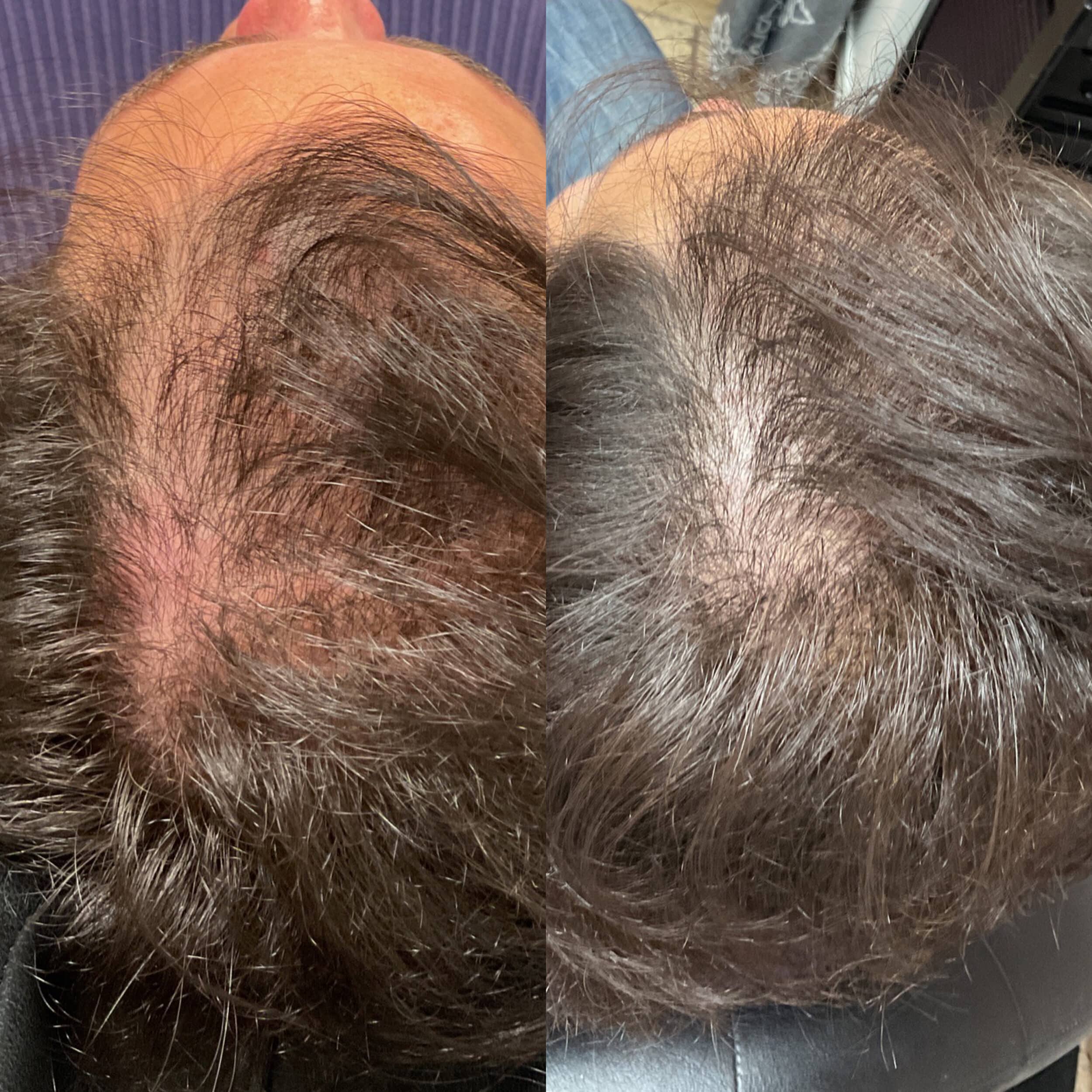 before after microneedling restoration