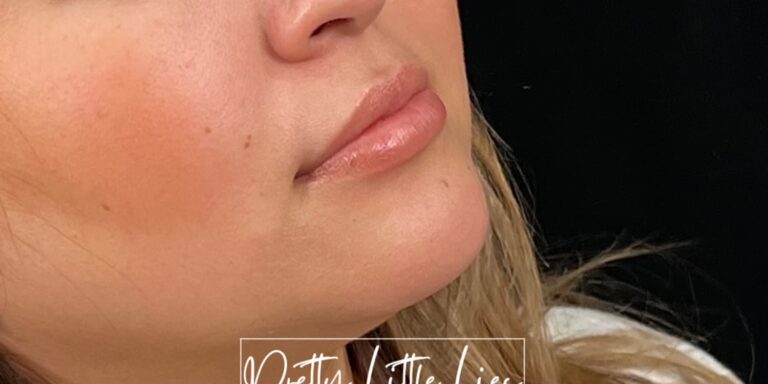Before Image: Lip Filler - right-front-oblique