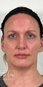 After Image: Full Face Filler