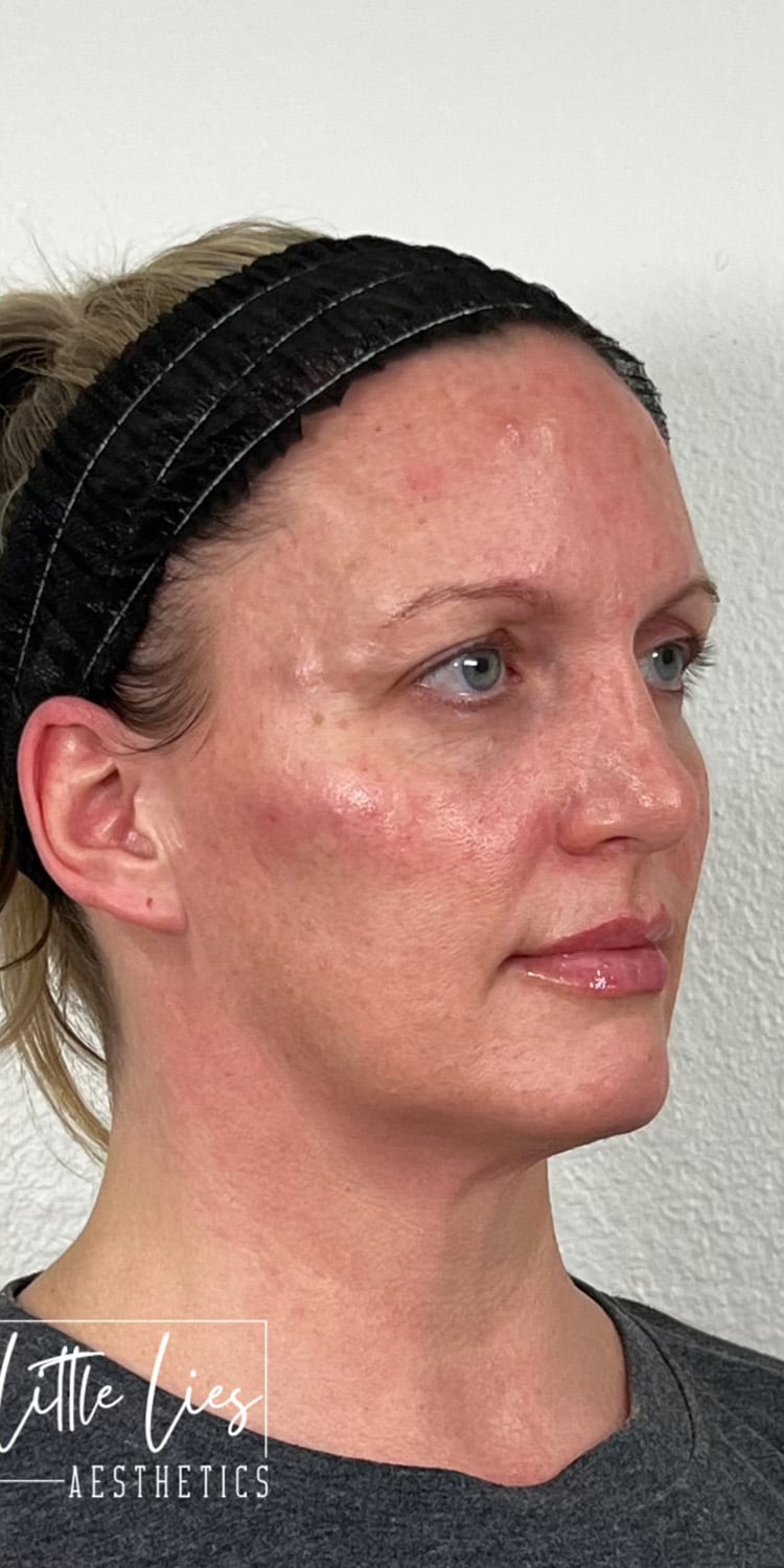 After Image: Full Face Filler - right-front-oblique
