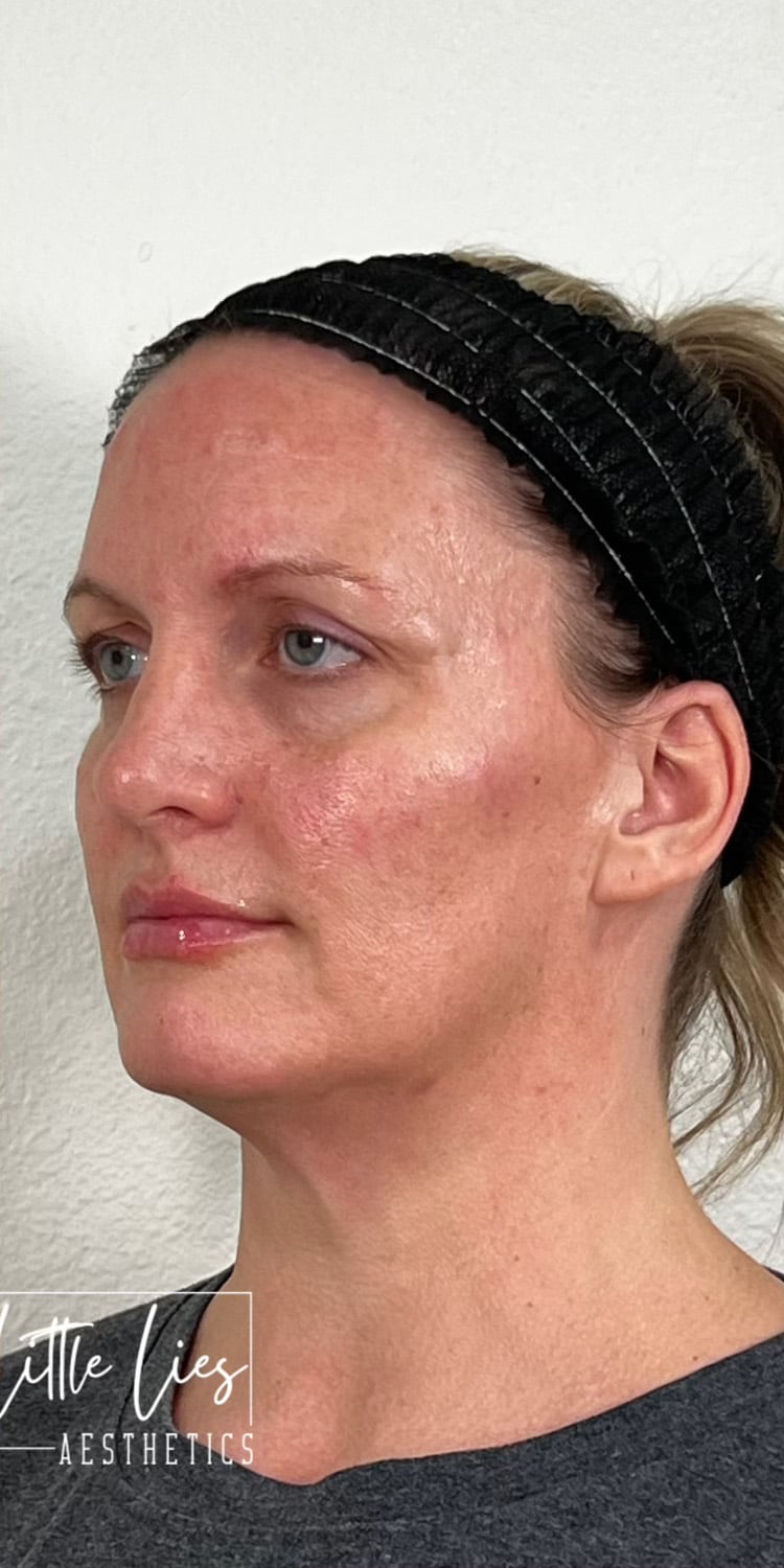 After Image: Full Face Filler - left-front-oblique