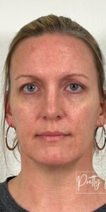 Before Image: Full Face Filler