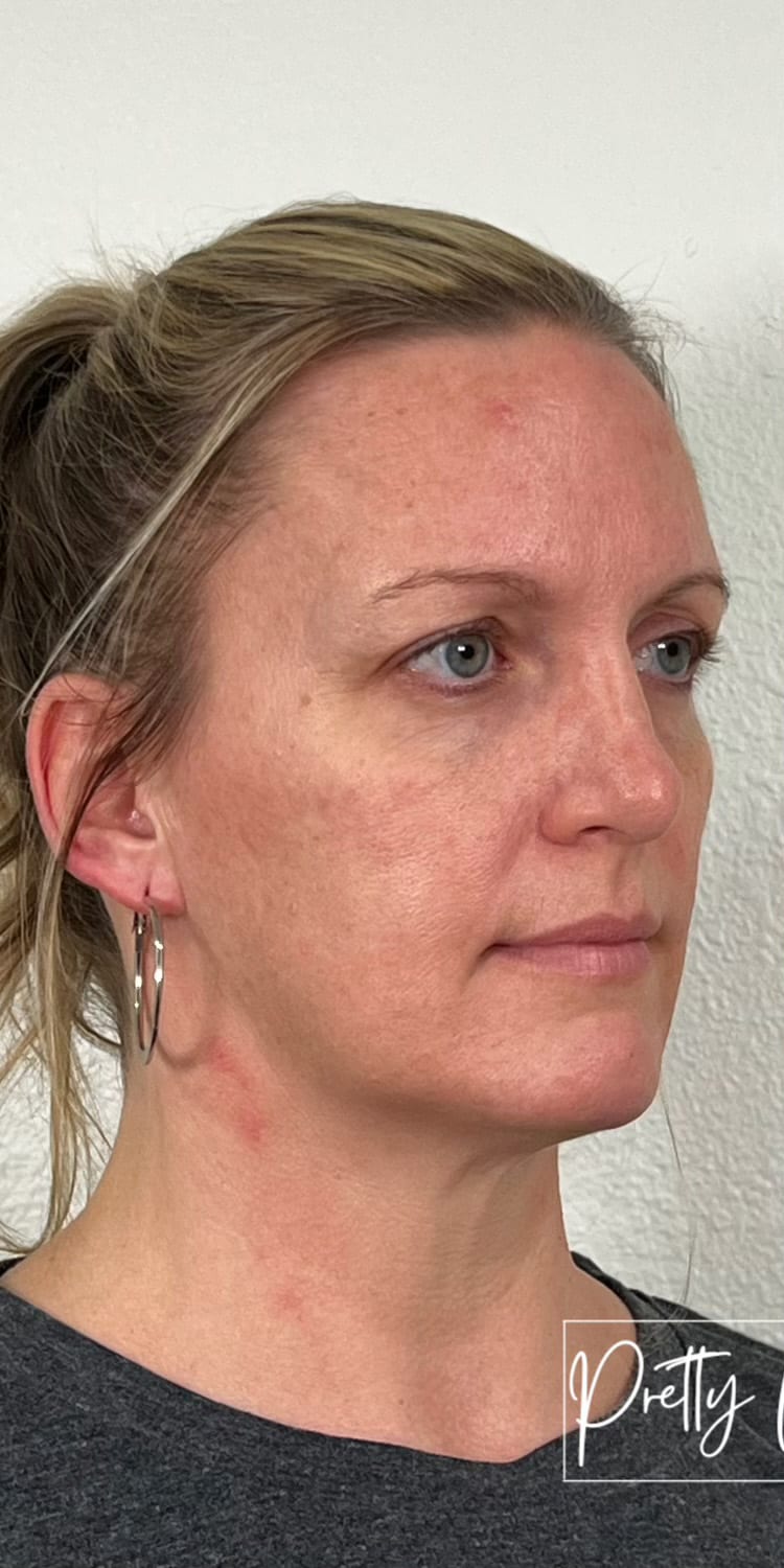 Before Image: Full Face Filler - right-front-oblique