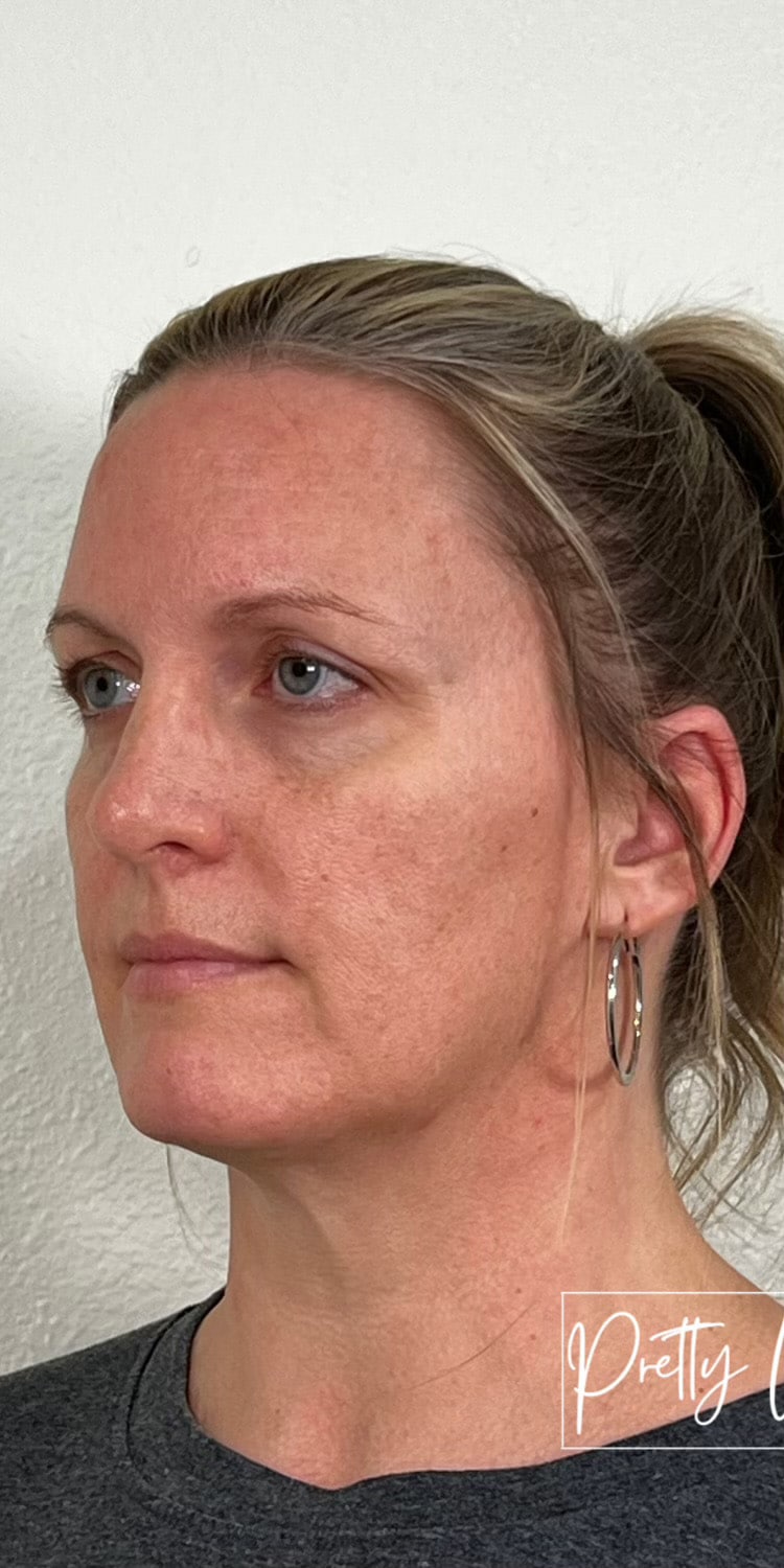 Before Image: Full Face Filler - left-front-oblique