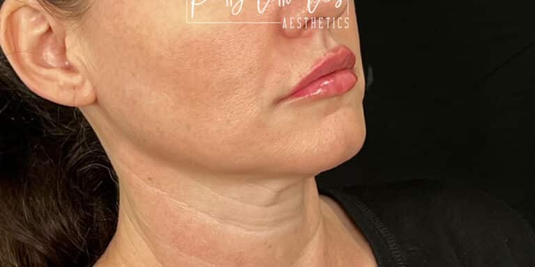 After Image: Lip Filler - right-front-oblique
