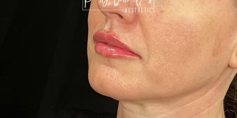 After Image: Lip Filler - left-front-oblique