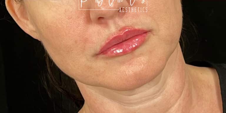After Image: Lip Filler - right-front-oblique