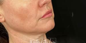 Before Image: Lip Filler