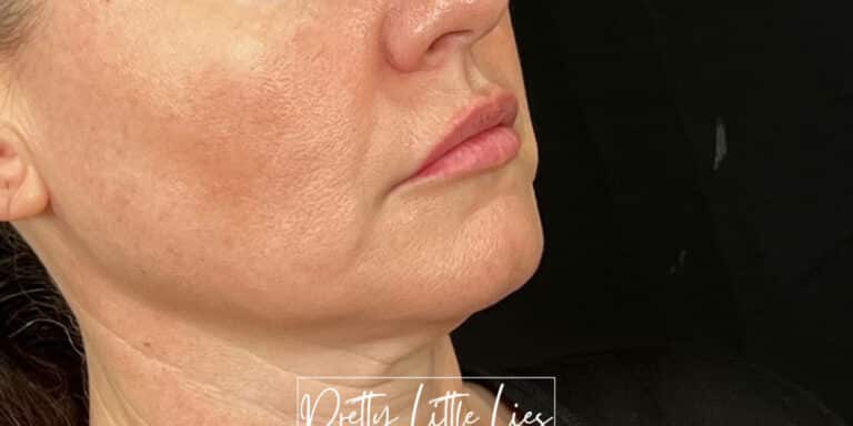 Before Image: Lip Filler - right-front-oblique