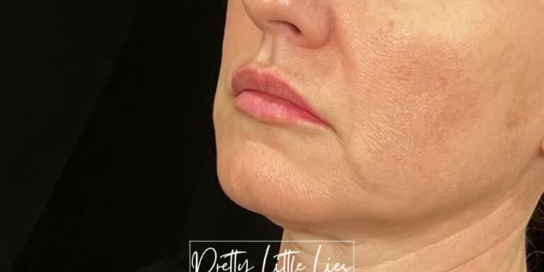 Before Image: Lip Filler - left-front-oblique