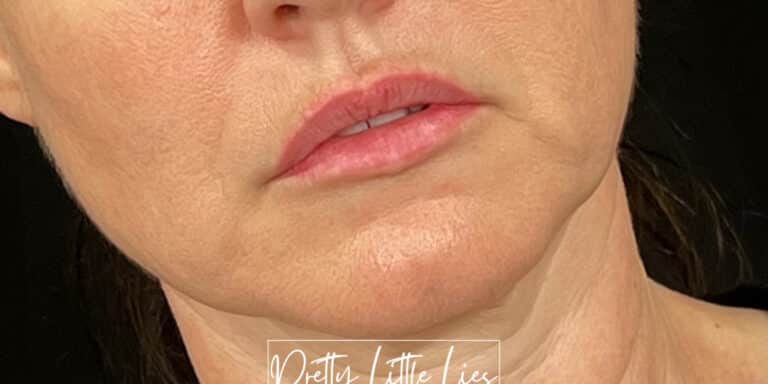 Before Image: Lip Filler - right-front-oblique