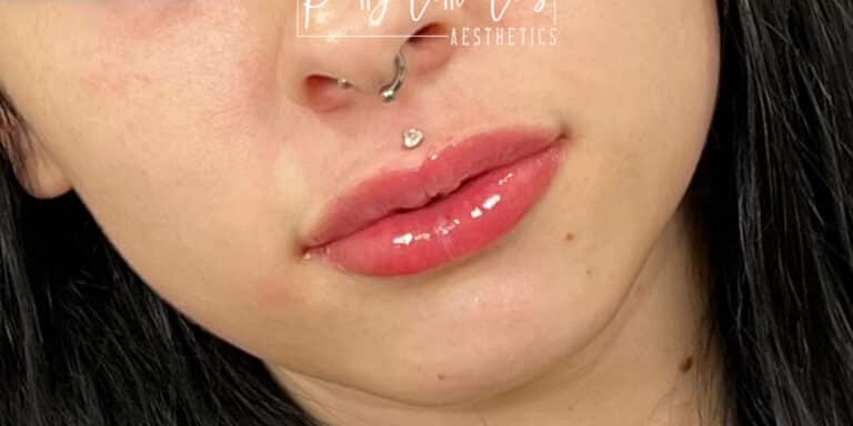 After Image: Lip Filler - left-front-oblique