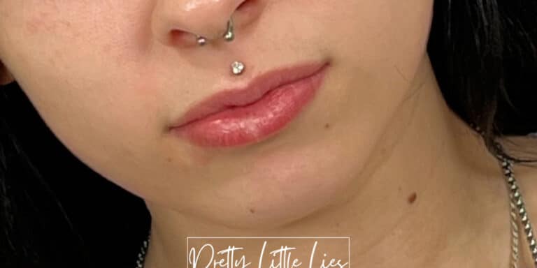 Before Image: Lip Filler - left-front-oblique