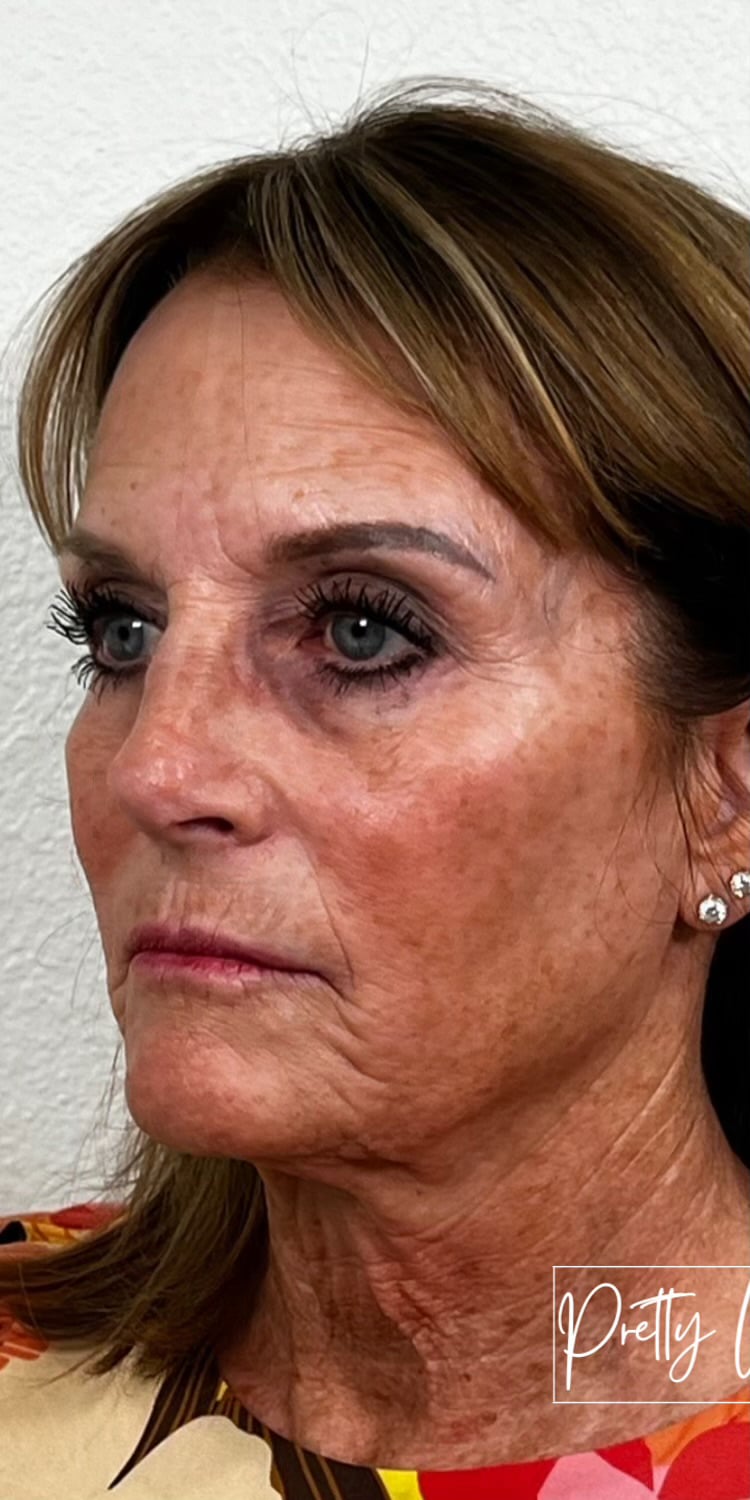 Before Image: Sculptra - left-front-oblique