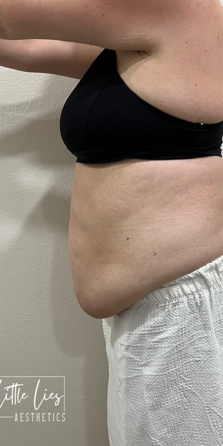 After Image: Weight Loss - left-side