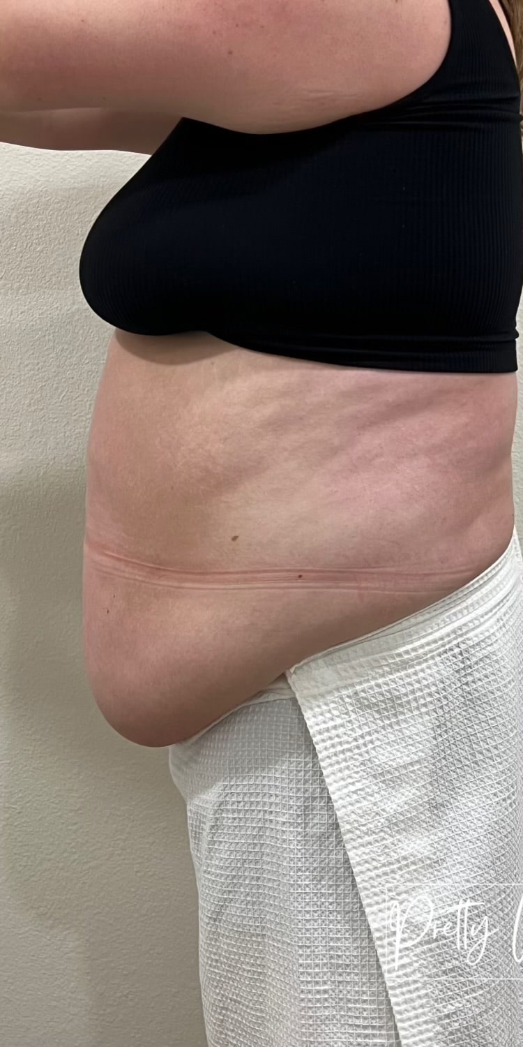 Before Image: Weight Loss - left-side