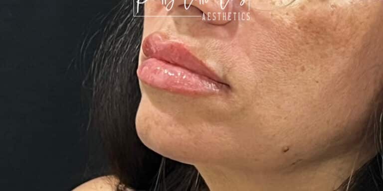 After Image: Lip Filler - left-front-oblique
