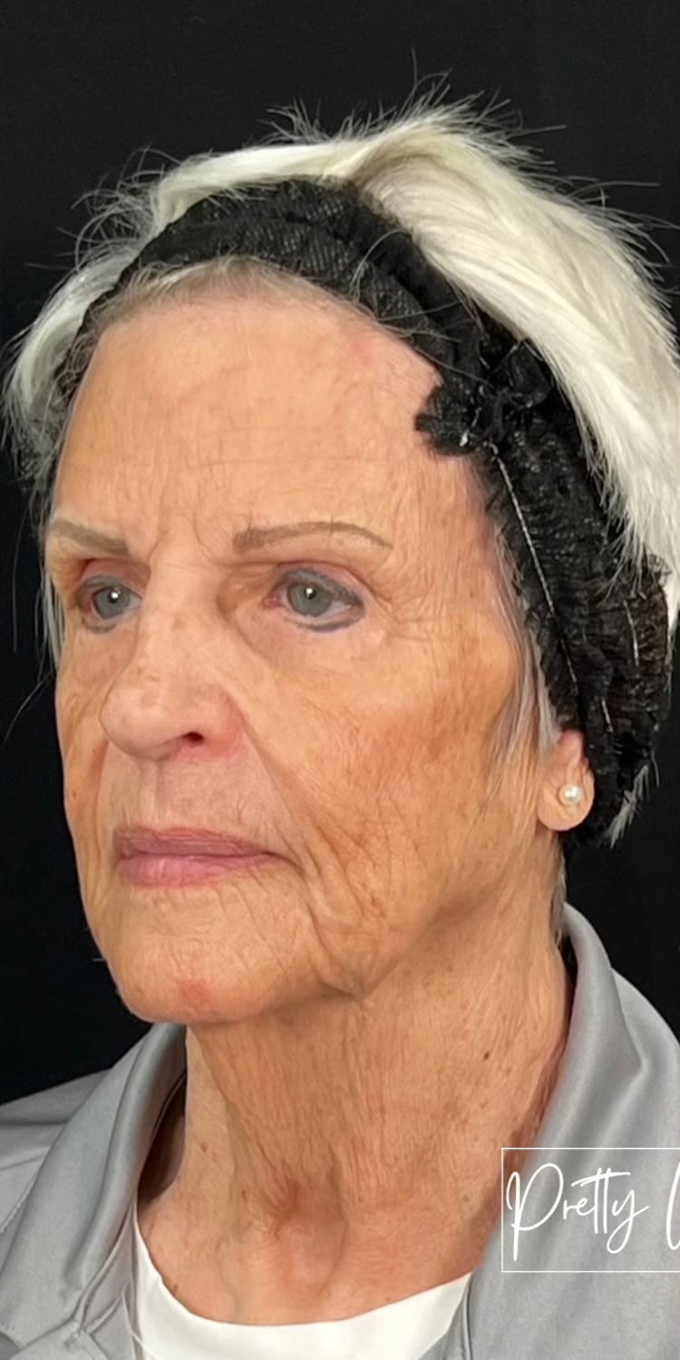 Before Image: Full Face Filler - left-front-oblique
