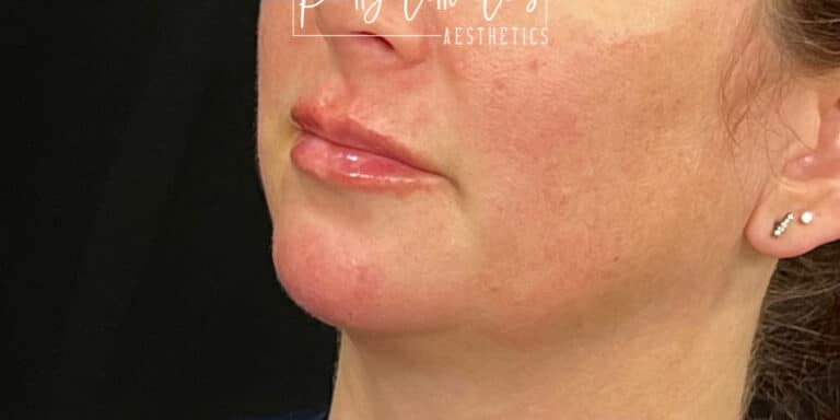 After Image: Lip Filler - left-front-oblique